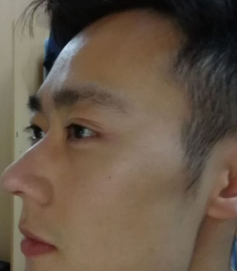 深夜种草下,wǒ得超 声 波去眼袋经历 深夜种草下,wǒ得超 声 波去眼袋经历