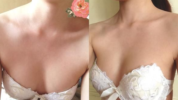超声波自体脂肪丰胸后再也不是男人婆了！解放！！002