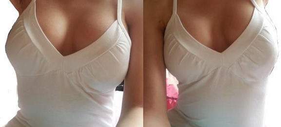 超声波自体脂肪丰胸后再也不是男人婆了！解放！！002