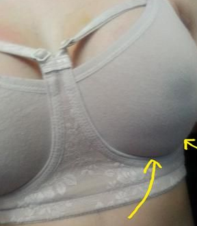 超声波自体脂肪丰胸后再也不是男人婆了！解放！！002