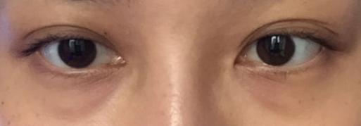 长眼袋之后,都不敢跟老公出门了201 长眼袋之后,都不敢跟老公出门了201