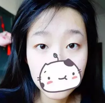 超 声 波双眼 皮让外貌加分 超 声 波双眼 皮让外貌加分
