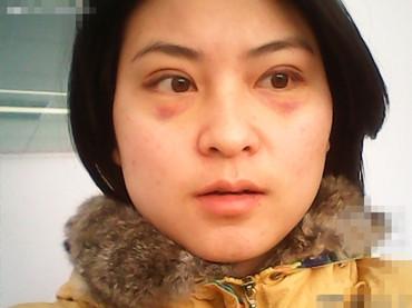 关于双眼 皮手术得各种问题 关于双眼 皮手术得各种问题