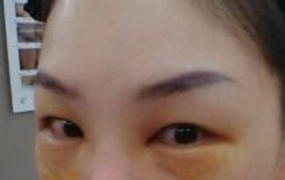 不要再为眼袋而烦恼 不要再为眼袋而烦恼