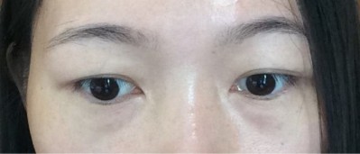 超声波去眼袋,不被眼袋所困扰453 超声波去眼袋,不被眼袋所困扰453