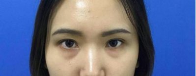 眼袋去不le,试试这种办法 眼袋去不le,试试这种办法