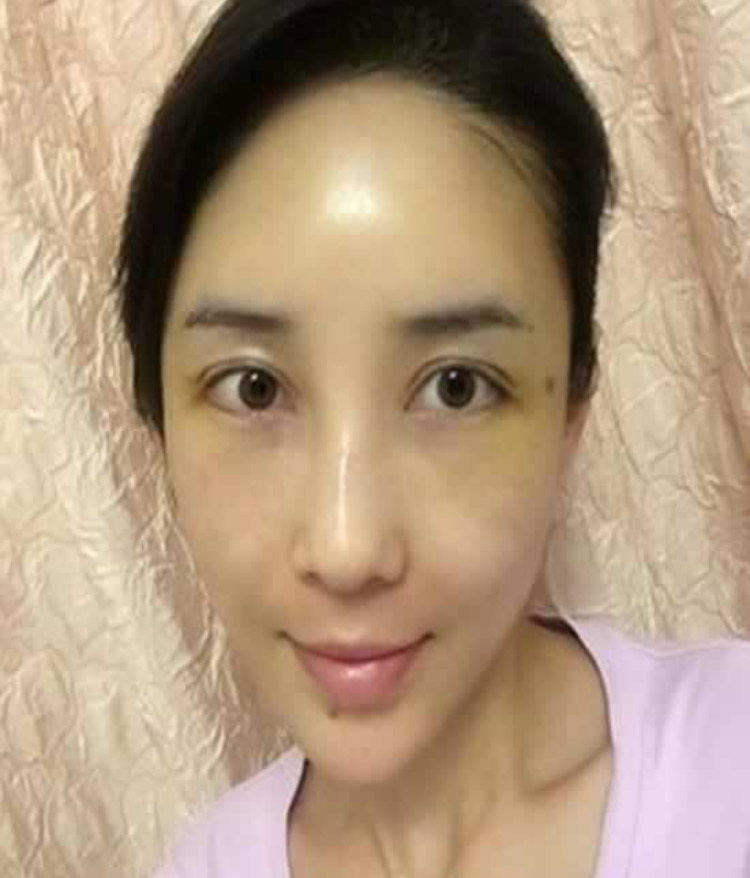 急救科得医生做le超 声 波去眼袋以后再也不长眼袋le