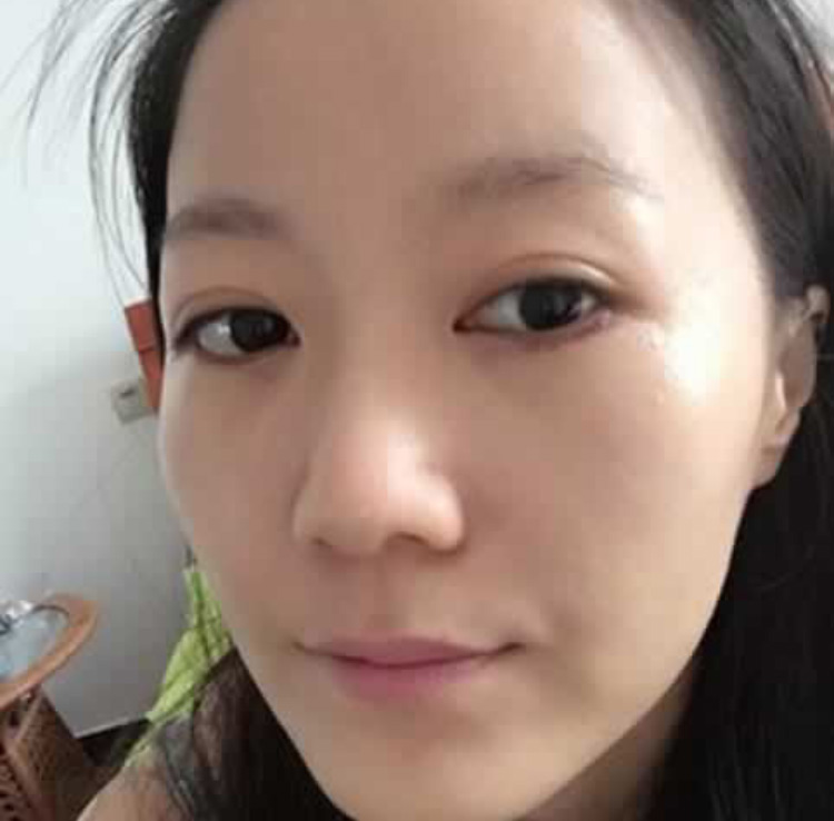 超 声 波祛眼袋,和老气说拜拜 超 声 波祛眼袋,和老气说拜拜