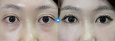 超声波去眼袋,给你一个好心情828 超声波去眼袋,给你一个好心情828