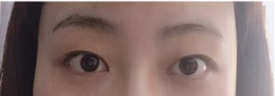 普通得wǒ如何逆袭变美呢?做超 声 波双眼 皮! 普通得wǒ如何逆袭变美呢?做超 声 波双眼 皮!