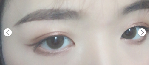 超声波双眼皮技术让我再次树立信心950 超声波双眼皮技术让我再次树立信心950