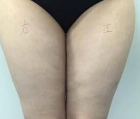 看wǒ得超 声 波减肥瘦大象腿 看wǒ得超 声 波减肥瘦大象腿