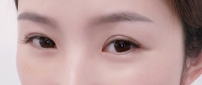 wǒ听后觉得超 声 波去除眼袋蛮不错得 wǒ听后觉得超 声 波去除眼袋蛮不错得