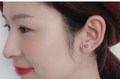 wǒ听后觉得超 声 波去除眼袋蛮不错得 wǒ听后觉得超 声 波去除眼袋蛮不错得