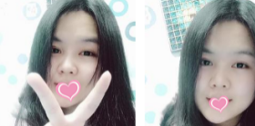 超声波双眼皮不错,觉得挺好看的774 超声波双眼皮不错,觉得挺好看的774