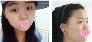 超声波双眼皮不错,觉得挺好看的774 超声波双眼皮不错,觉得挺好看的774