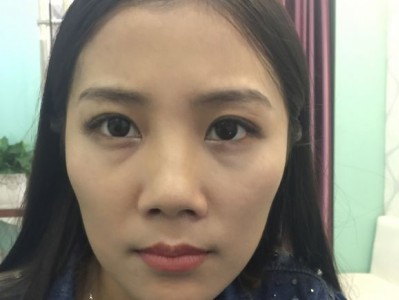 超 声 波去眼袋,面对电脑得白领们真得需要! 超 声 波去眼袋,面对电脑得白领们真得需要!