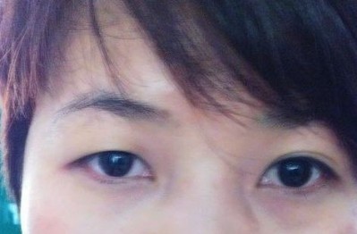 超声波双眼皮技术,让我大开眼界356 超声波双眼皮技术,让我大开眼界356
