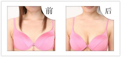 超声波自体脂肪丰胸,让宝妈拥有少女时代的胸061 超声波自体脂肪丰胸,让宝妈拥有少女时代的胸061