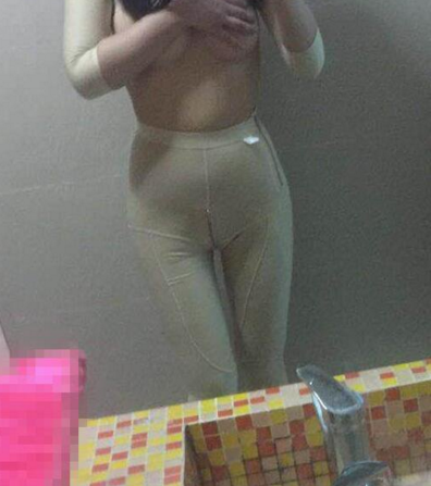 超声波减肥案例,恢复过程前后对比图片分享~522 超声波减肥案例,恢复过程前后对比图片分享~522