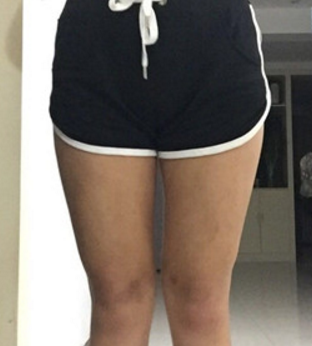 超 声 波减肥大腿吸脂真实案例分享