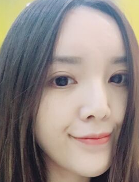超 声 波双眼 皮后都说wǒ像刘诗诗? 超 声 波双眼 皮后都说wǒ像刘诗诗?