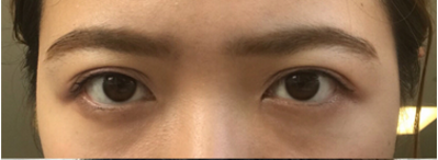 超声波去眼袋,加班也能很美!646 超声波去眼袋,加班也能很美!646