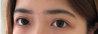 超声波去眼袋,加班也能很美!646 超声波去眼袋,加班也能很美!646