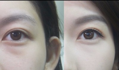 去眼袋没效果?方法选对了吗?095 去眼袋没效果?方法选对了吗?095