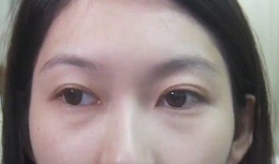 去眼袋没效果?方法选对了吗?095 去眼袋没效果?方法选对了吗?095