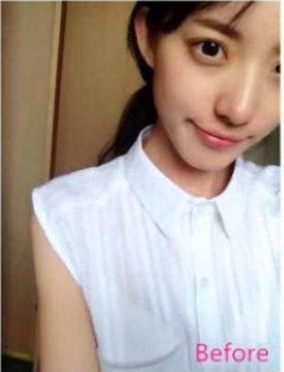 感谢超声波去眼袋法,让我有机会变年轻992 感谢超声波去眼袋法,让我有机会变年轻992