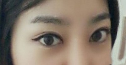超声波双眼皮,对得起青春879 超声波双眼皮,对得起青春879