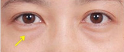 超声波去眼袋轻松对付眼袋816 超声波去眼袋轻松对付眼袋816
