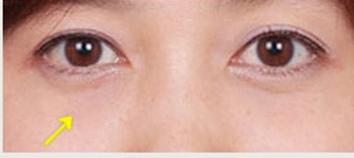 超声波去眼袋轻松对付眼袋816 超声波去眼袋轻松对付眼袋816