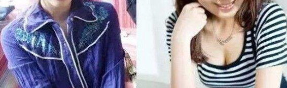 产后宝妈塑形大法——超声波自体脂肪丰胸手术927 产后宝妈塑形大法——超声波自体脂肪丰胸手术927