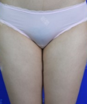 超声波减肥瘦大腿前后差距太大，简直辣眼睛啦~552