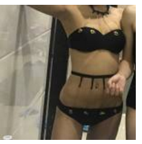 经过多番考虑以后wǒ就到超雅做le靠谱得自体脂肪丰胸