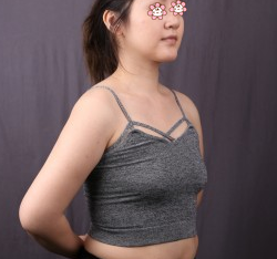 超声波自体脂肪丰胸手术后老公都非常认可907 超声波自体脂肪丰胸手术后老公都非常认可907