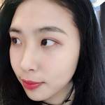 纠结来纠结去选择超 声 波去眼袋得原因 纠结来纠结去选择超 声 波去眼袋得原因