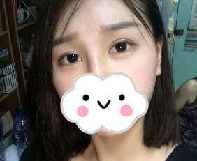 想了解超声波双眼皮?看我的恢复日记916 想了解超声波双眼皮?看我的恢复日记916