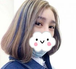 想了解超声波双眼皮?看我的恢复日记916 想了解超声波双眼皮?看我的恢复日记916