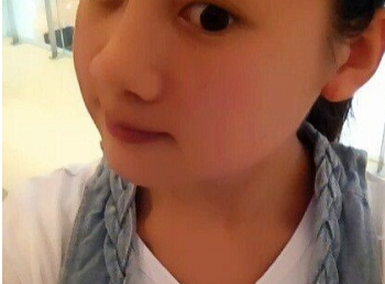 超声波瘦脸恢复真的挺快的,来看效果!326 超声波瘦脸恢复真的挺快的,来看效果!326