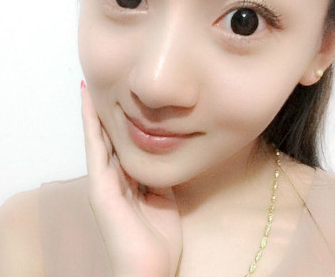 超声波瘦脸恢复真的挺快的,来看效果!326 超声波瘦脸恢复真的挺快的,来看效果!326