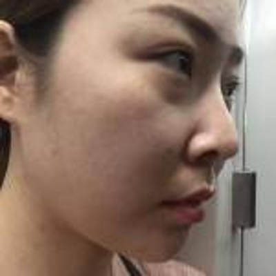 超声波去眼袋,不畏相亲412 超声波去眼袋,不畏相亲412
