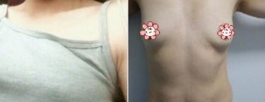 亲身感受超 声 波自体脂肪丰胸效果 亲身感受超 声 波自体脂肪丰胸效果