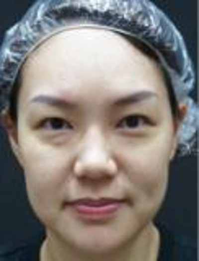 超声波去眼袋,轻松解决讨厌的眼袋665 超声波去眼袋,轻松解决讨厌的眼袋665