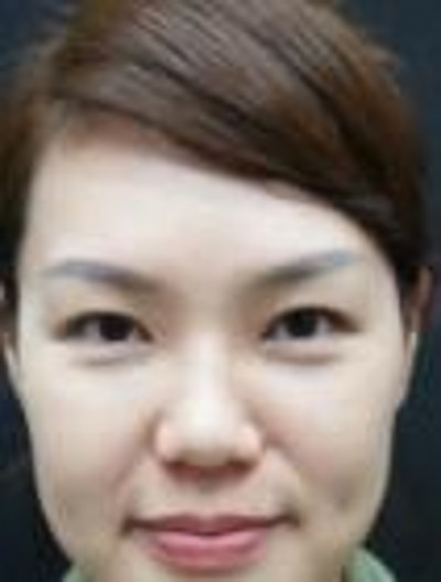 超声波去眼袋,轻松解决讨厌的眼袋665 超声波去眼袋,轻松解决讨厌的眼袋665
