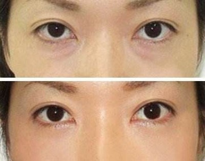 超声波去眼袋,彻底根治眼袋472 超声波去眼袋,彻底根治眼袋472