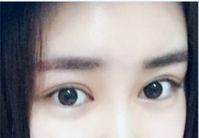 超声波双眼皮,感觉自己好漂亮啊411 超声波双眼皮,感觉自己好漂亮啊411