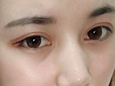 超声波双眼皮,感觉自己好漂亮啊411 超声波双眼皮,感觉自己好漂亮啊411